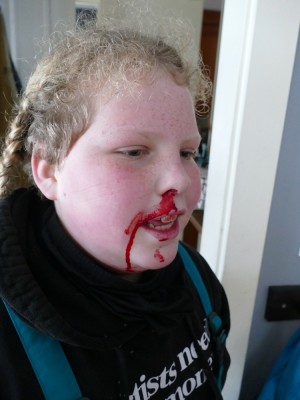 Harvey with blood all over his face from a bloody nose